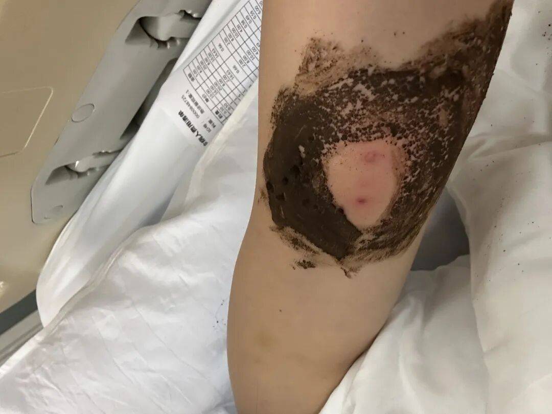 4名游客景区内遭马蜂袭击,旅游度假区:是森林公园不卖门票,蜇伤先就医后提供证据投诉